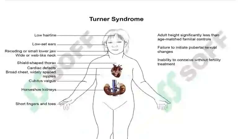 Shershevskiy-Turner syndrome 3