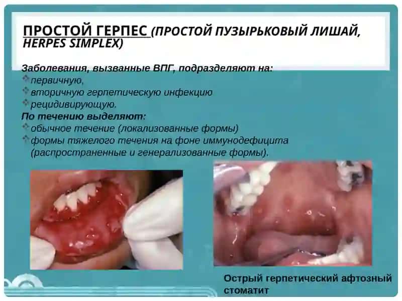 Вирусные дерматозы 3