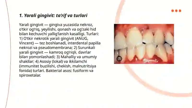 Yarali gingivit 3