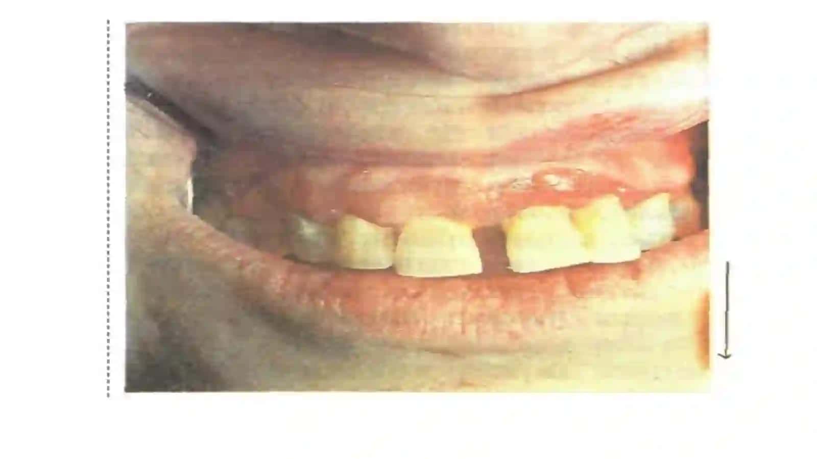 Pemfigus 3