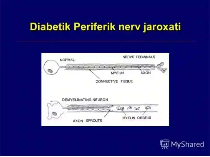 Diabetik nefropatiya 4