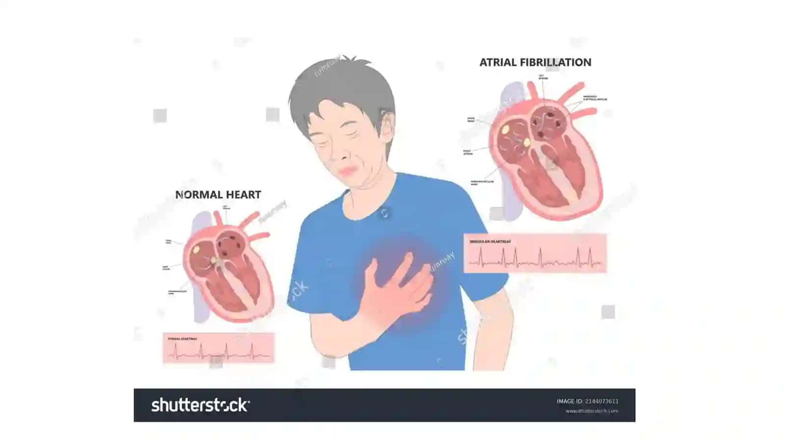 Bo’lmachalarfibrilyatsiyasi 4