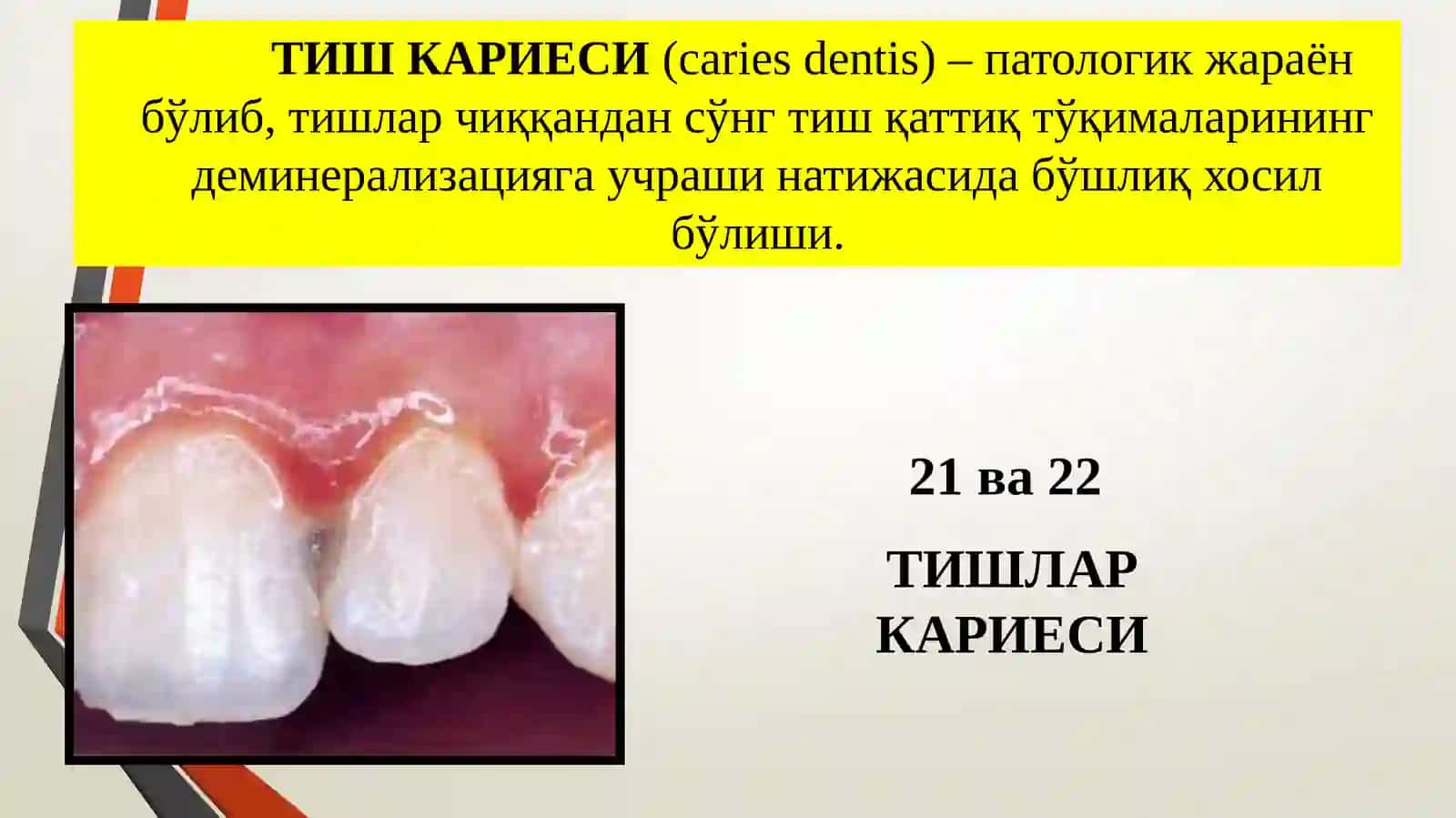 Кариес хақида тушунча 4