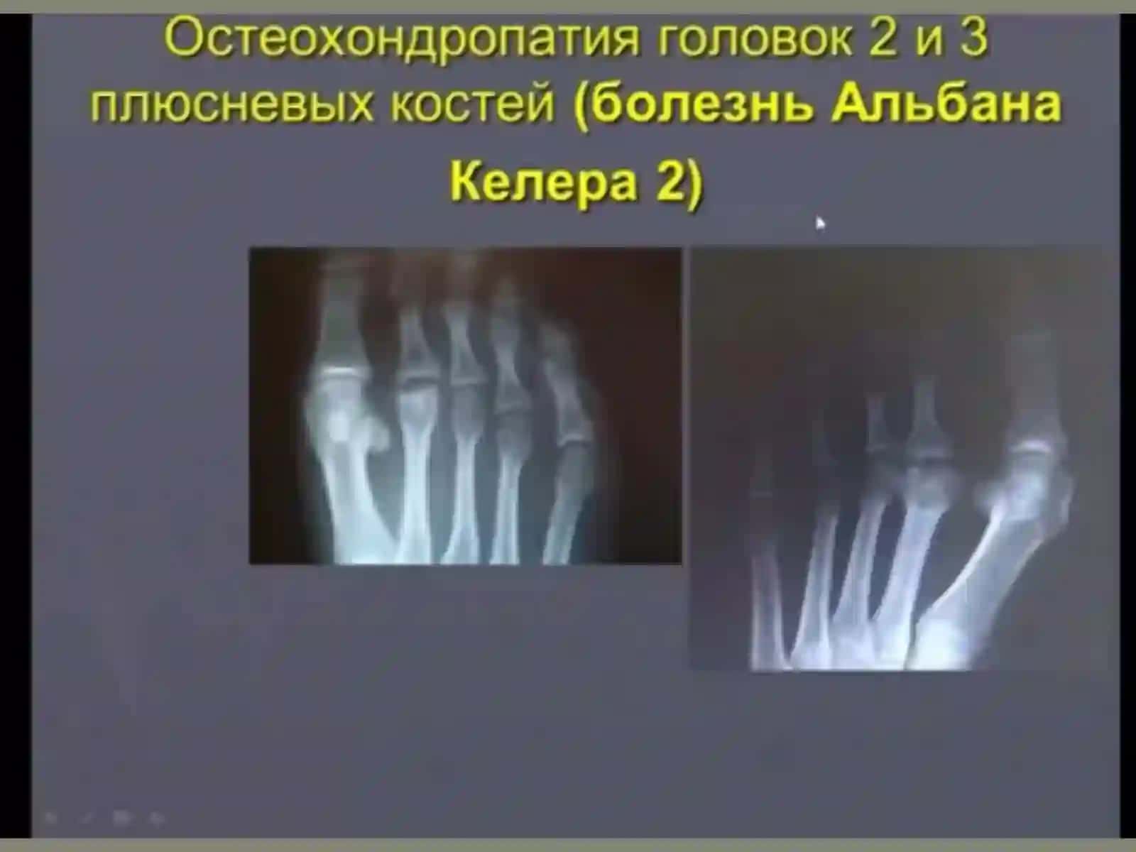 OSTEOXONDROPATIYA 4
