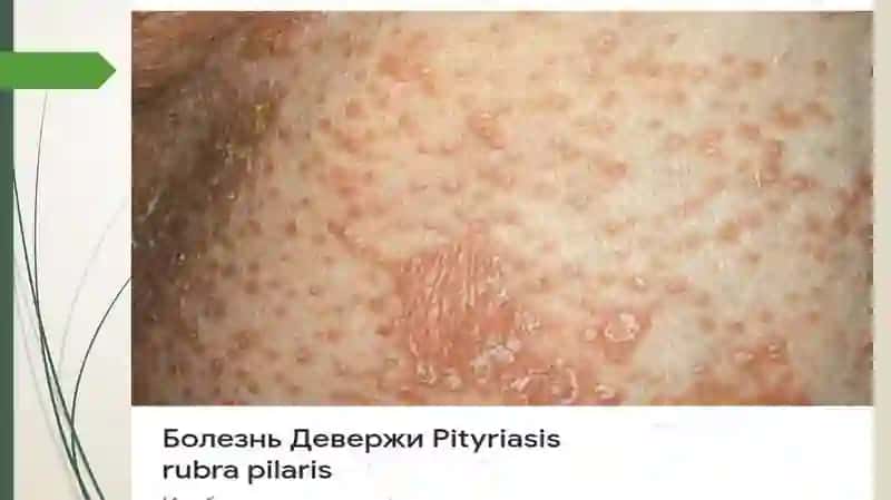 Deverji kasalligi 4