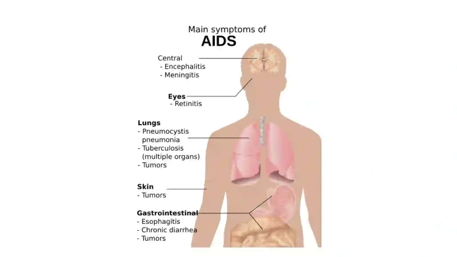 AIDS, Tuberculosis, Malaria ppt 4
