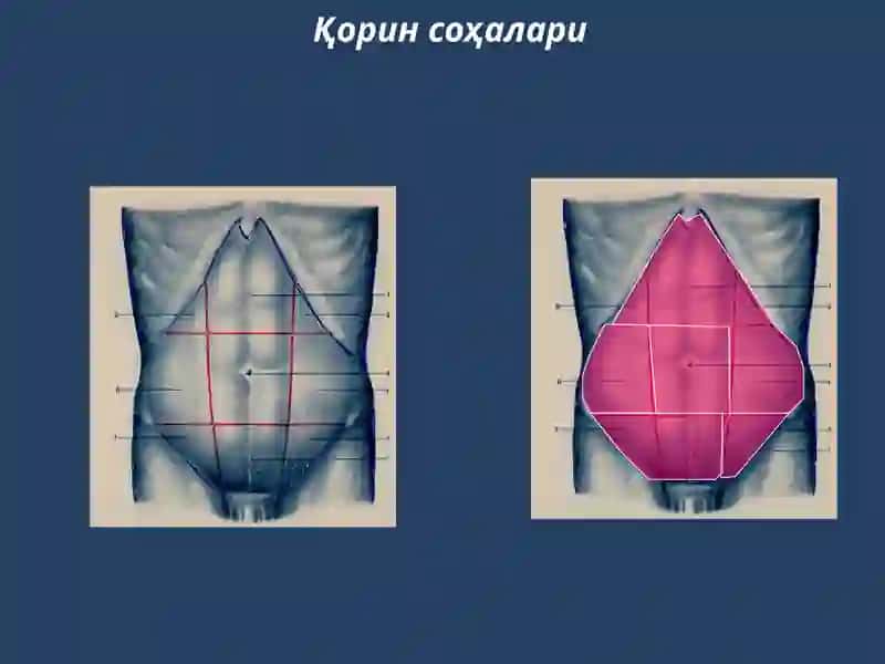 Гинекологик перитонитлар 4