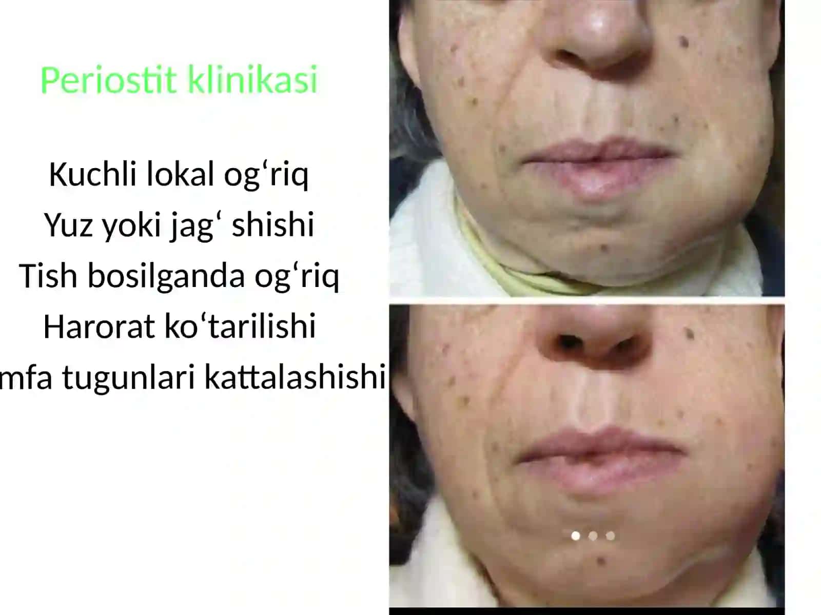 Periostit, abscessvaflegmona 4