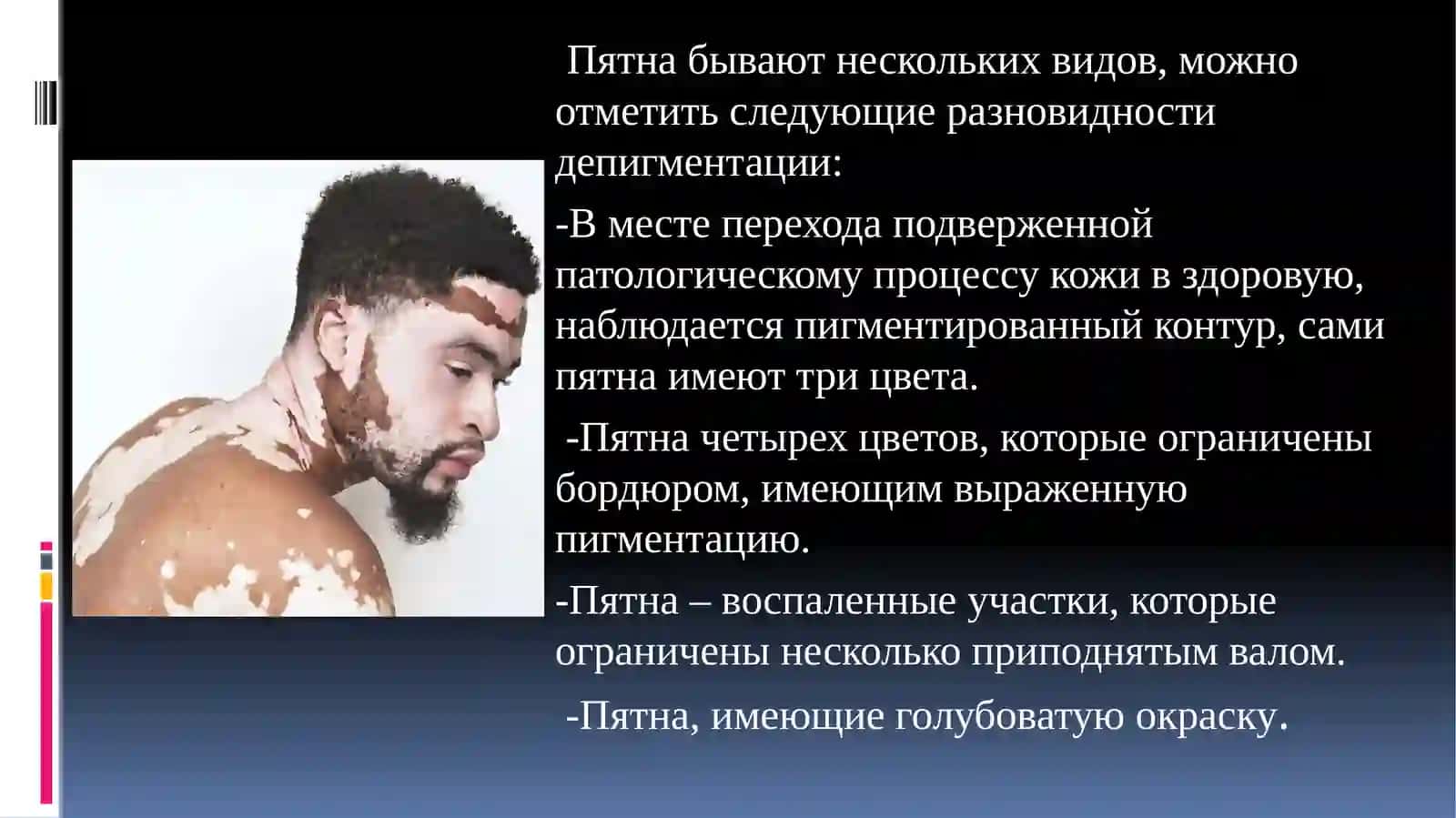 Витилиго 4