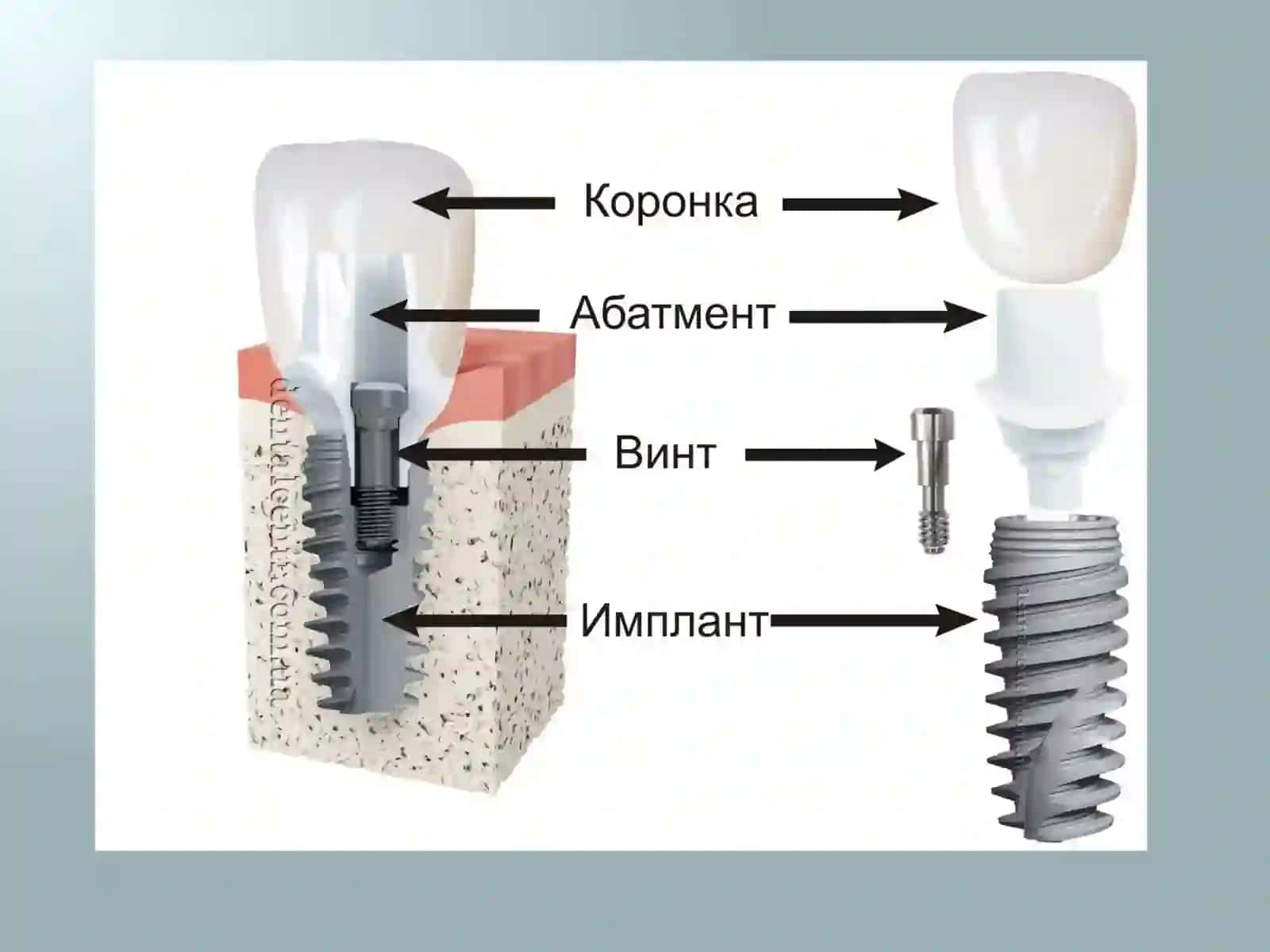 Implant 4
