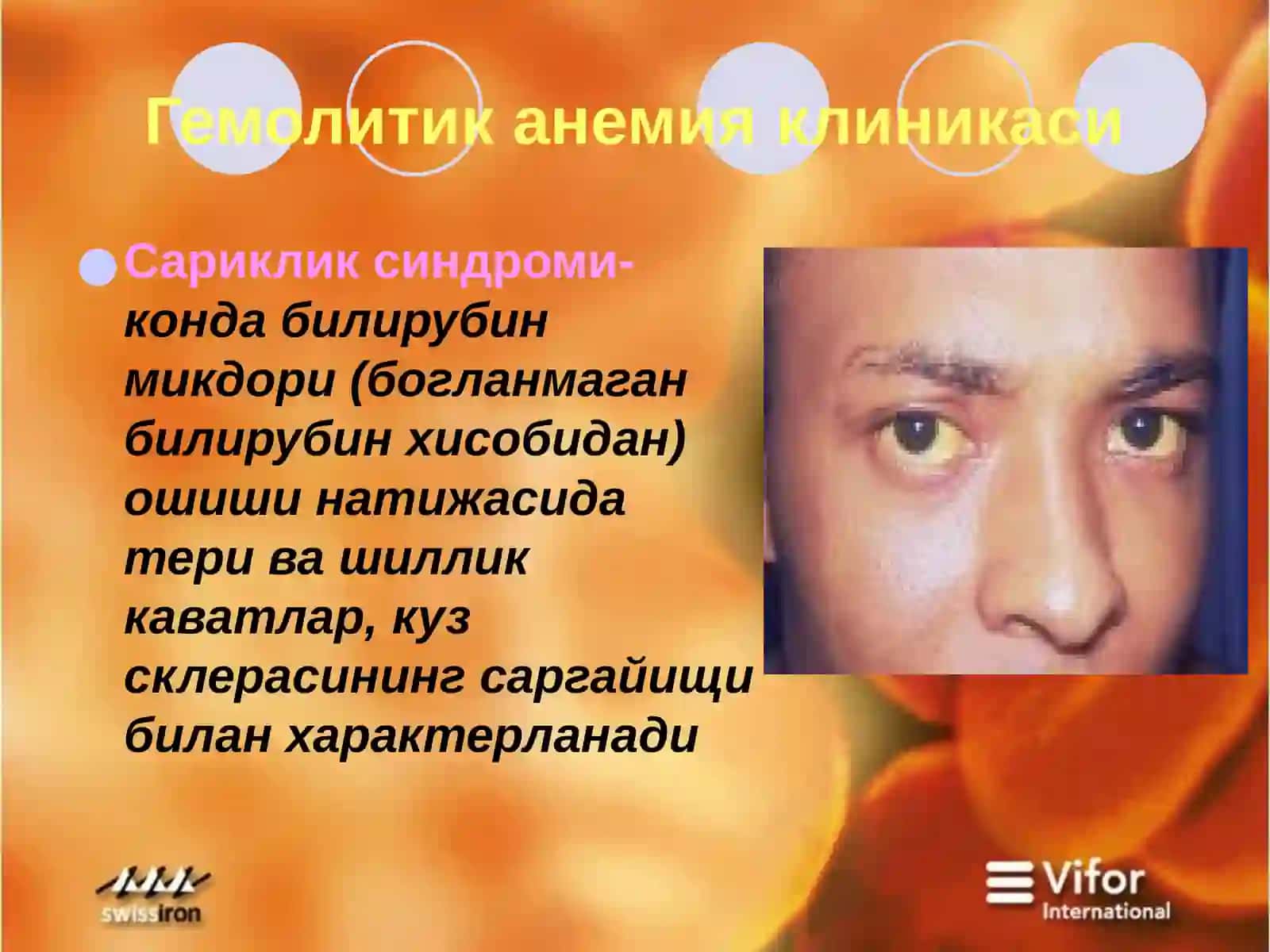 Гемолитик анемия 4