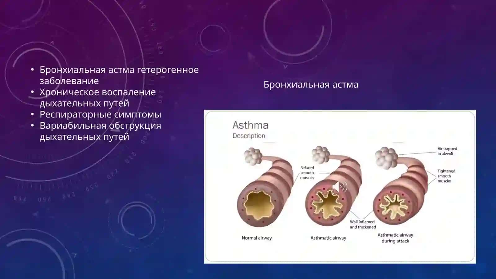 Бронхиальная астма 4