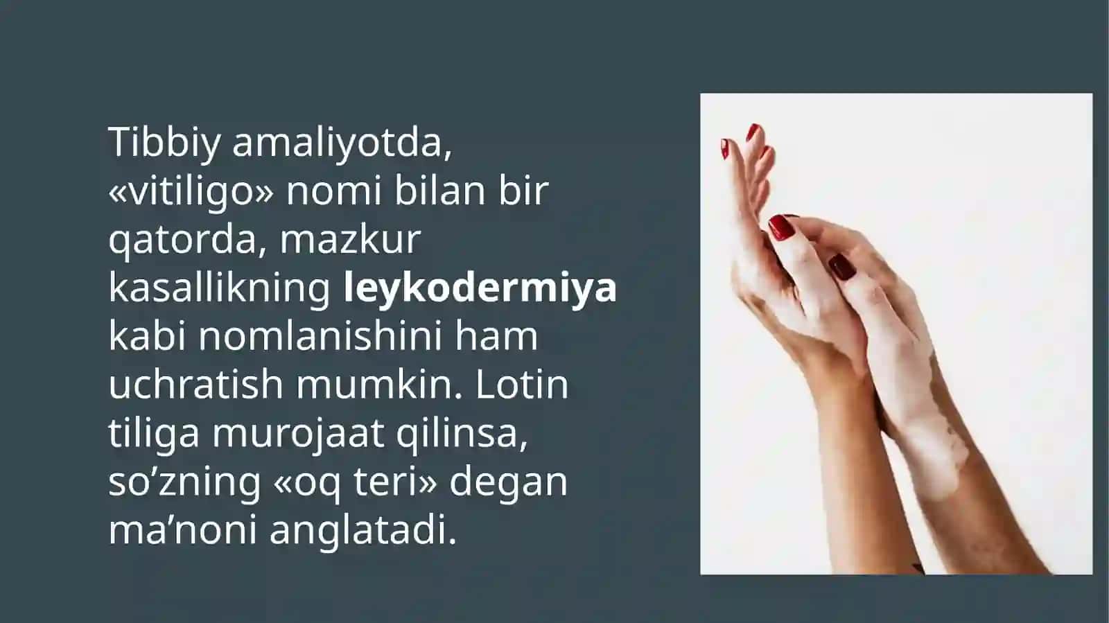 VITILIGO VA UNING ZAMONAVIY DAVOLASH USULLARI 4