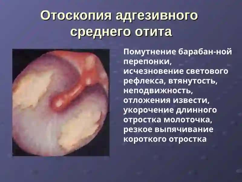Болезнь Меньера 4