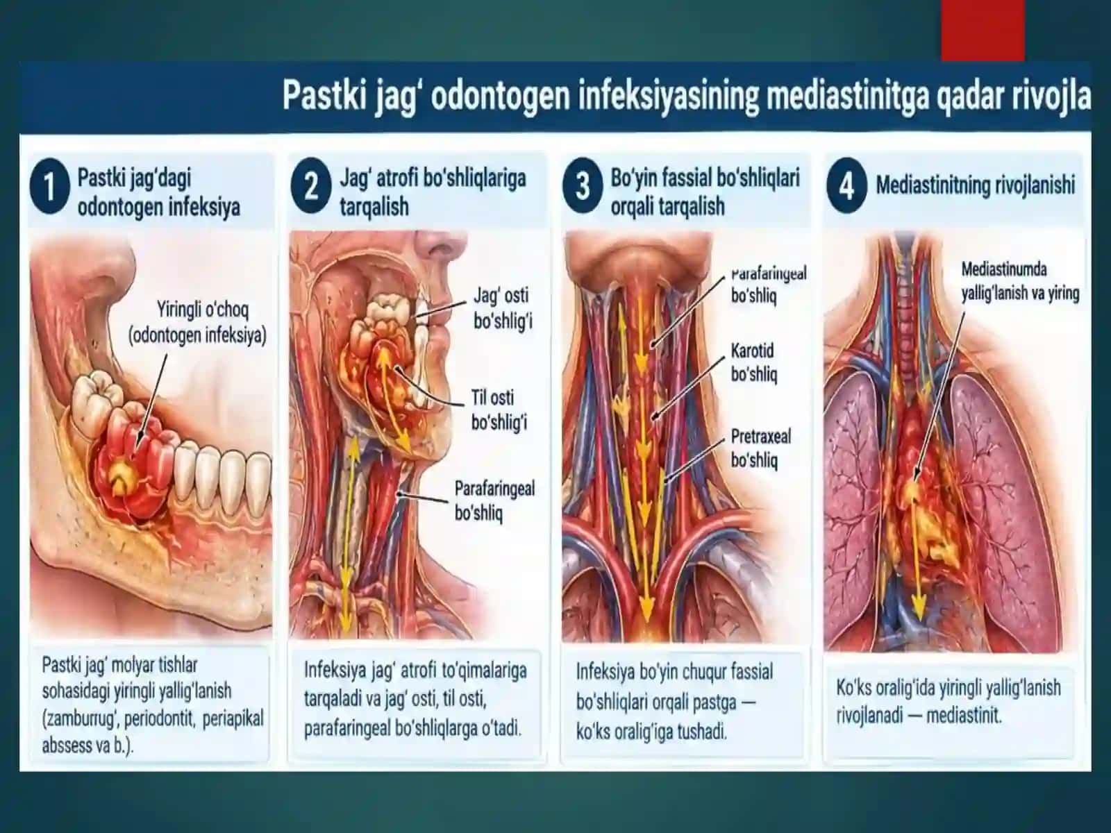 MEDIASTENIT 4