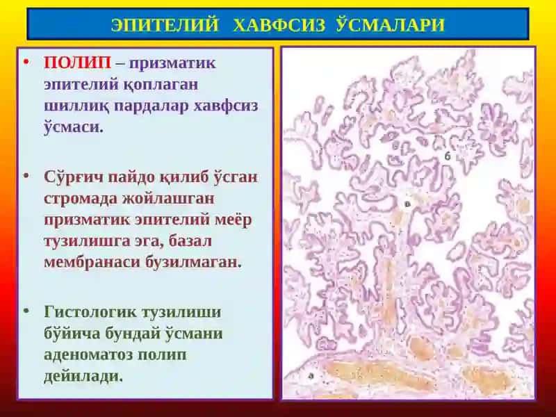 Ўсмалар. Мезенхимал ўсмалар 4