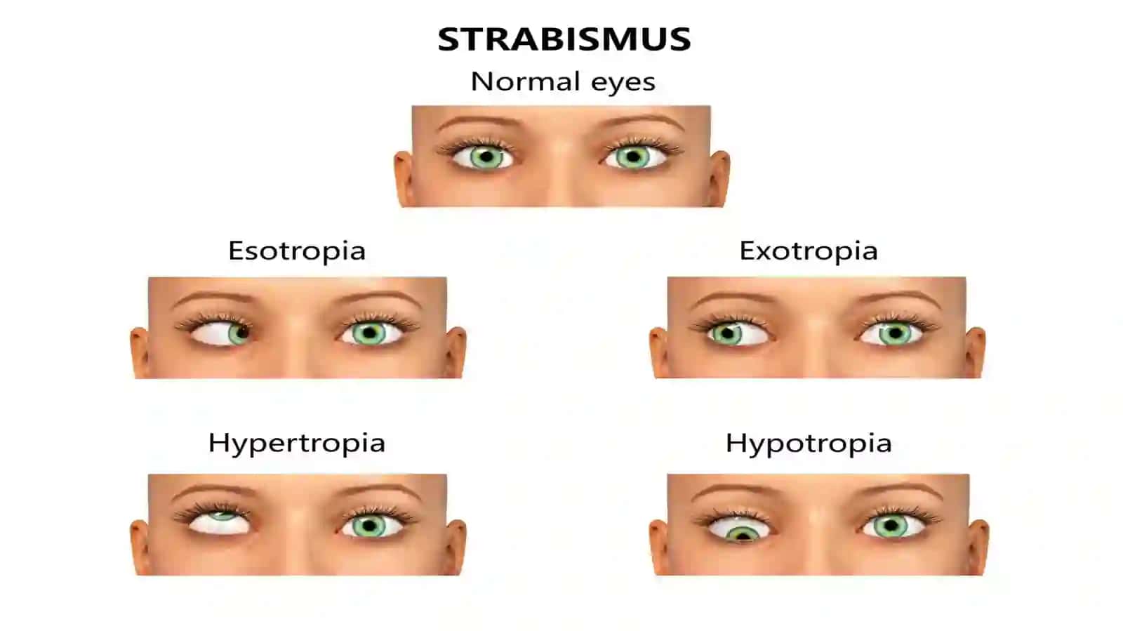 GʻILAYLIK (STRABISMUS) 4