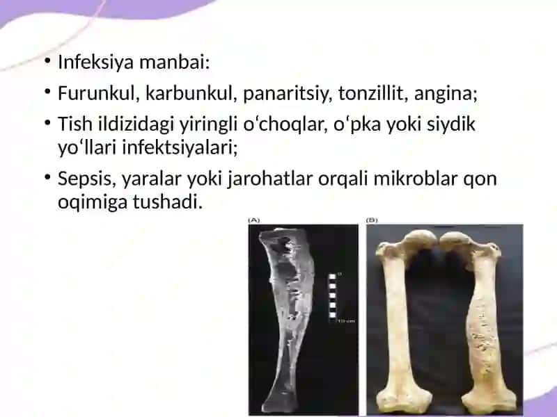 Gematogenli osteomiyelit 4