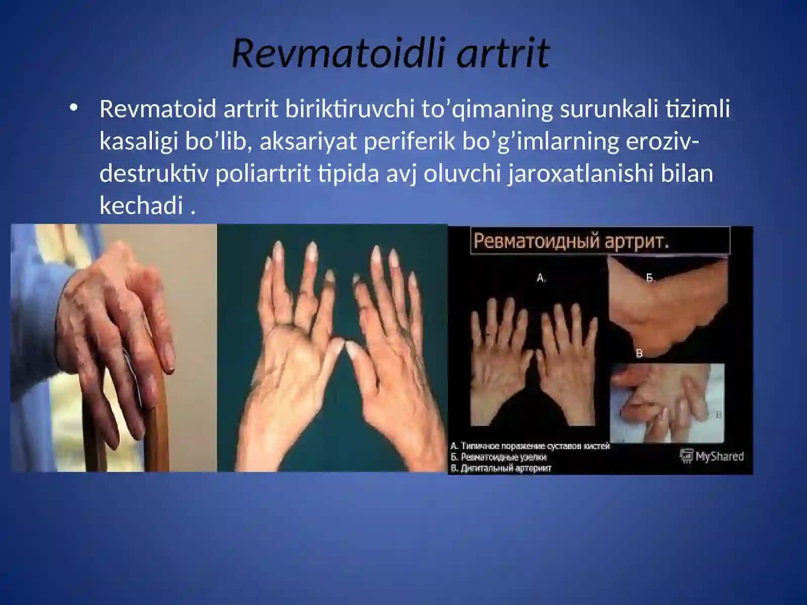 Revmatoid artrit 4