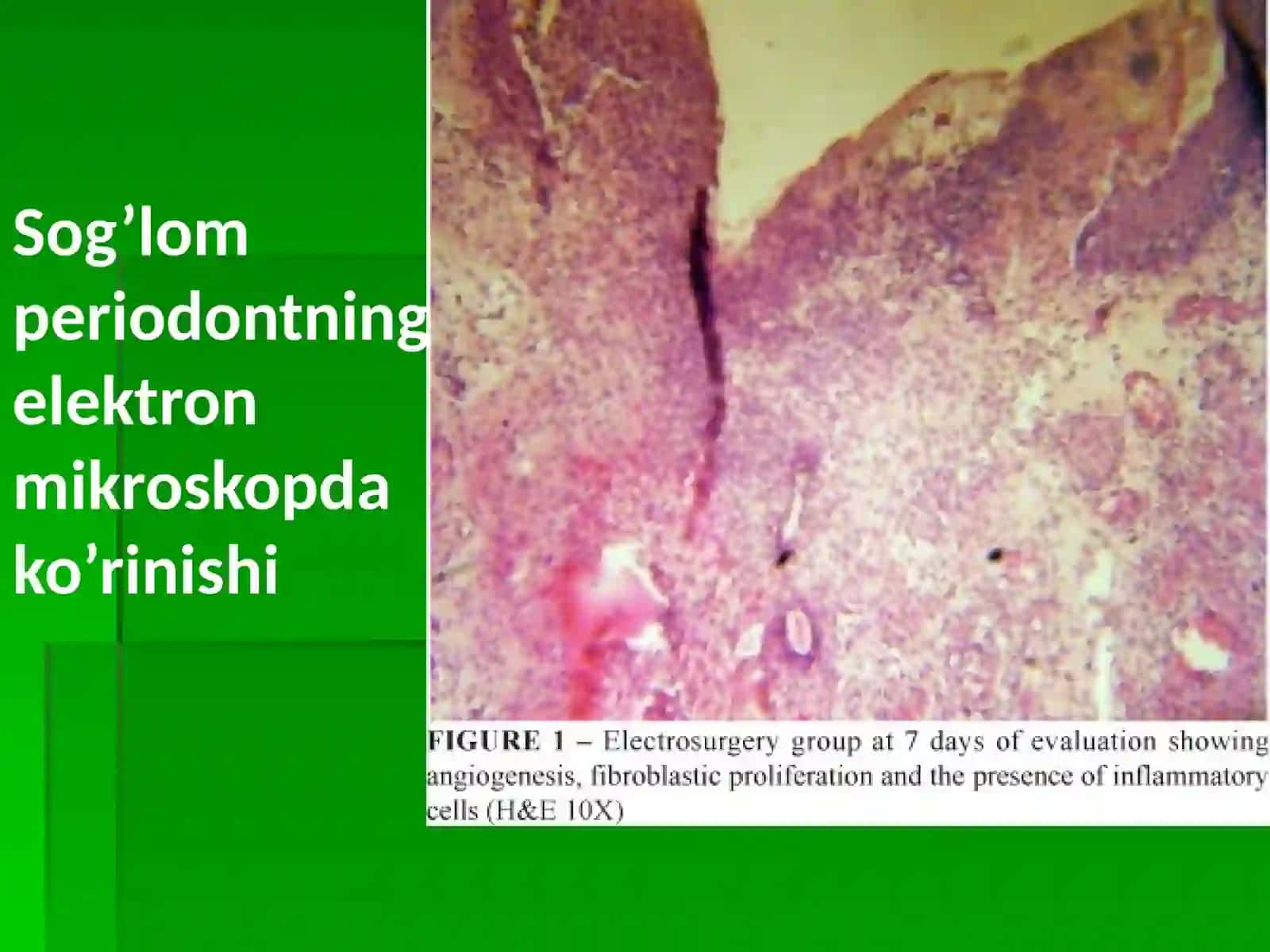Periodontit 4