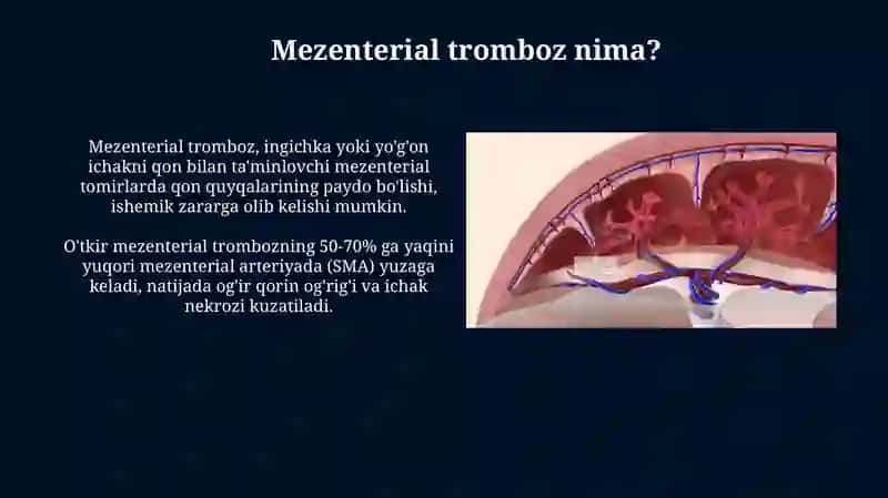 Mezentrialtromboz 4