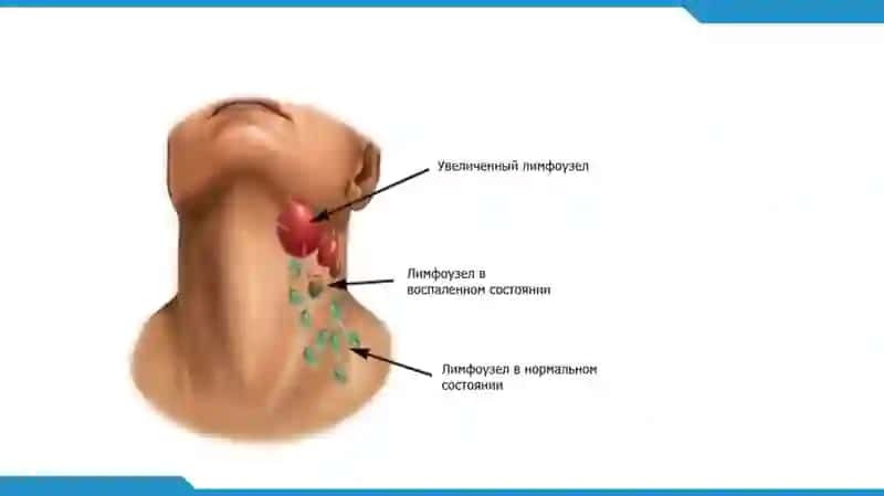 ЛИМФОМАЛАР 4