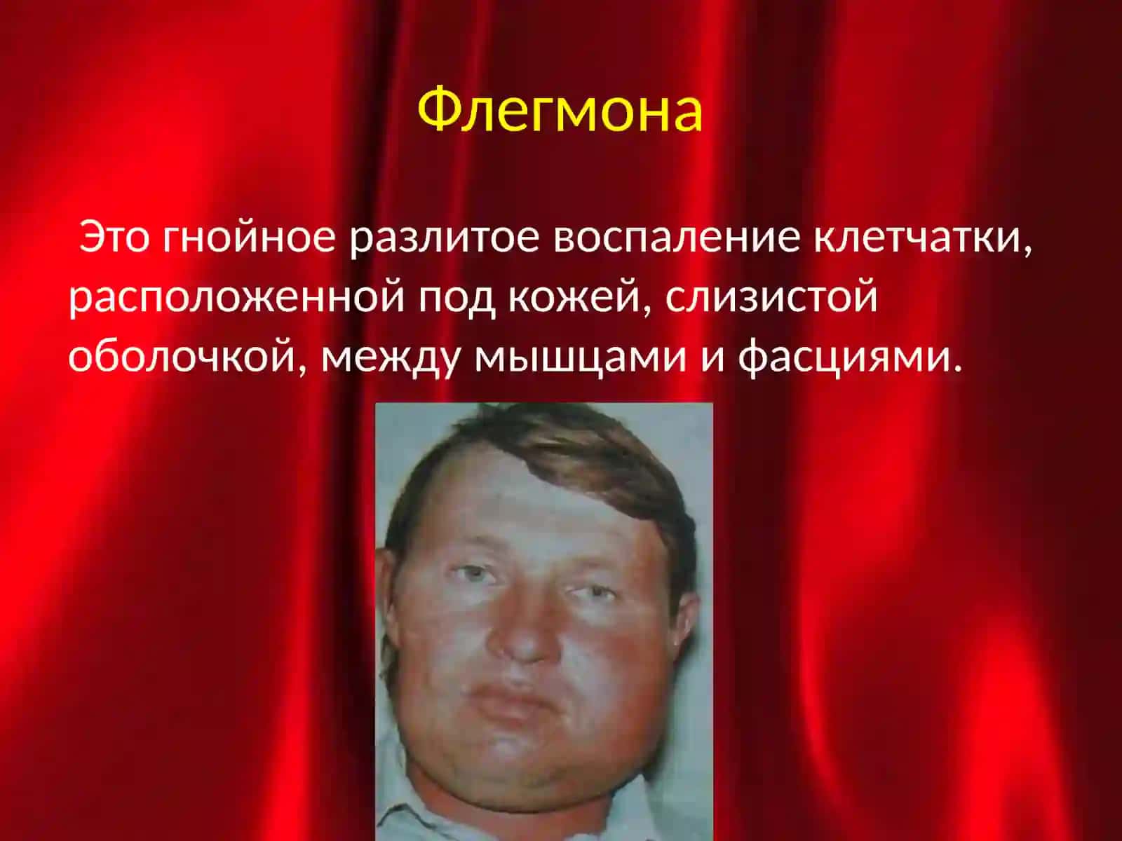 Абсцесс 4