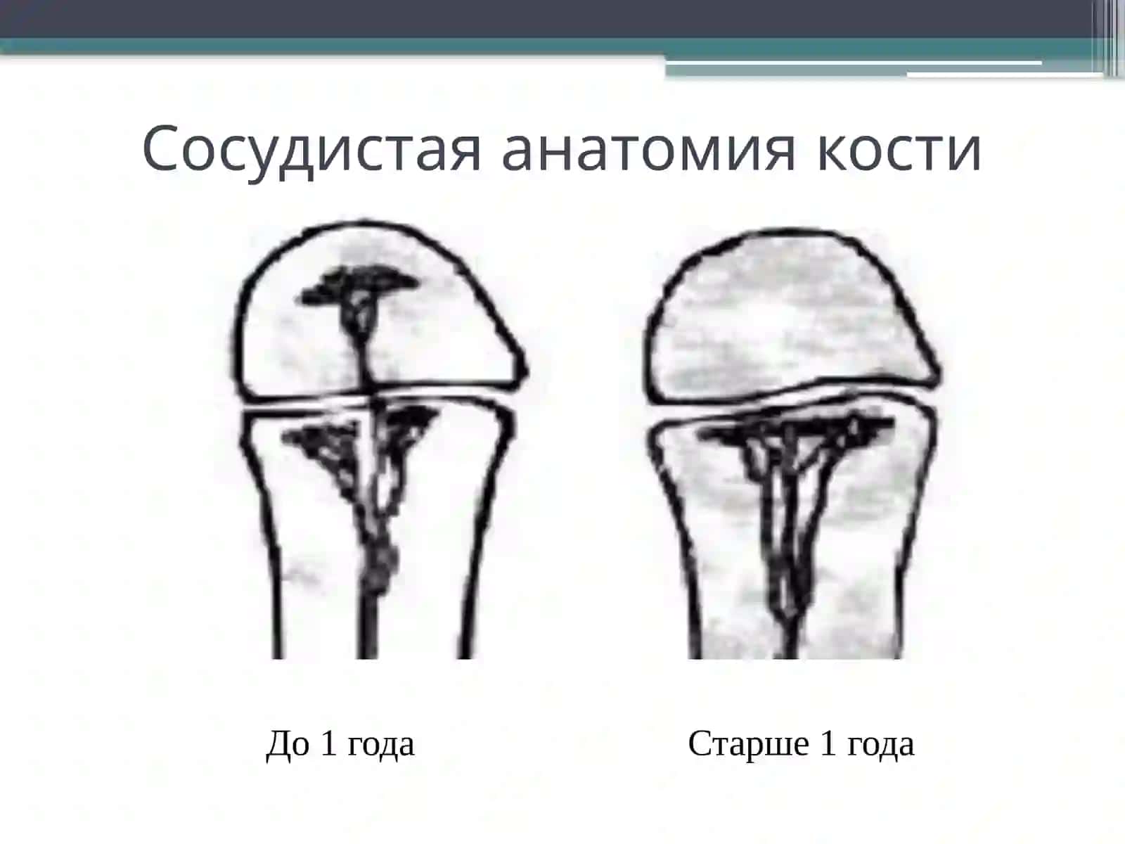 Острый гематогенный остеомиелит у детей 4