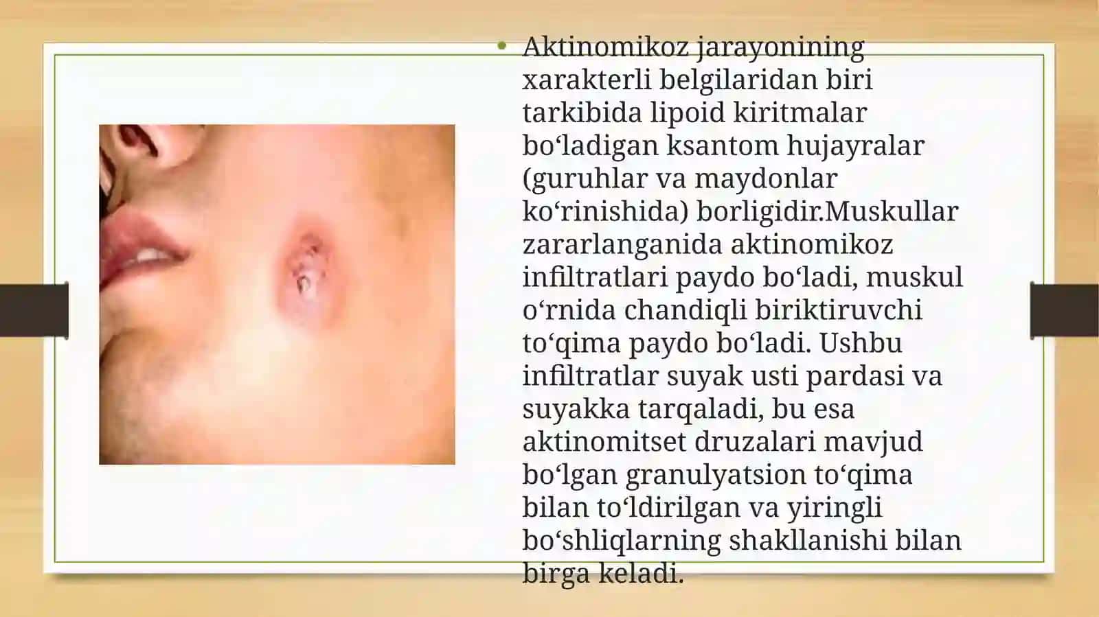 Aktinomikoz 4