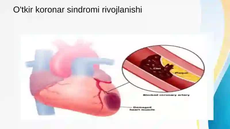 O'tkir koranar sindromi 4