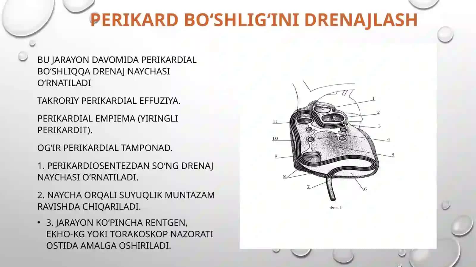 Perikarditlarda operatsiyalar 4