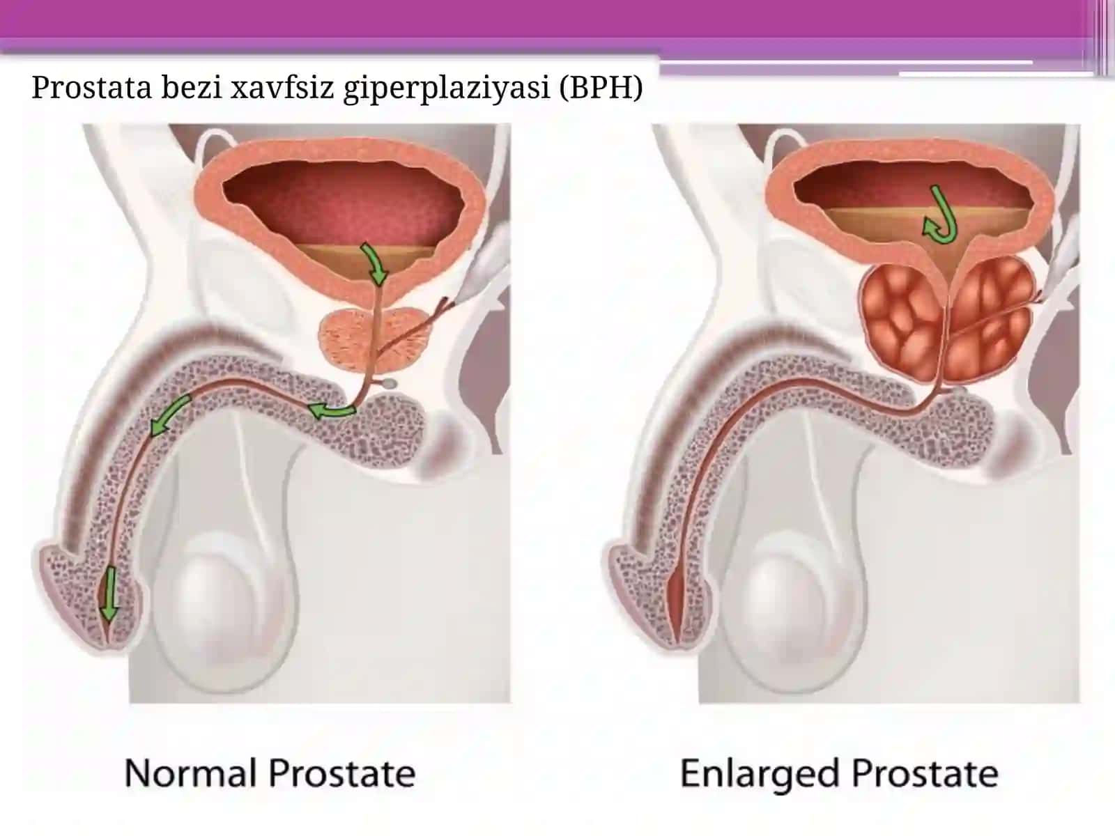 Prostata bezi o’smalari 4