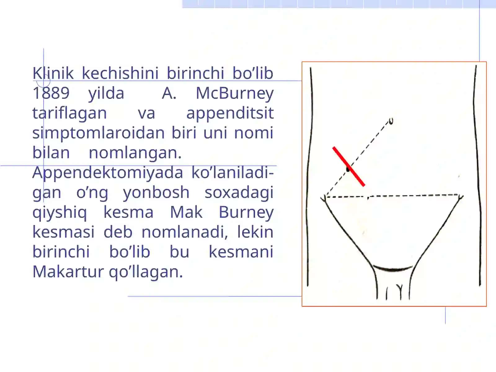 Appendektomiya 4