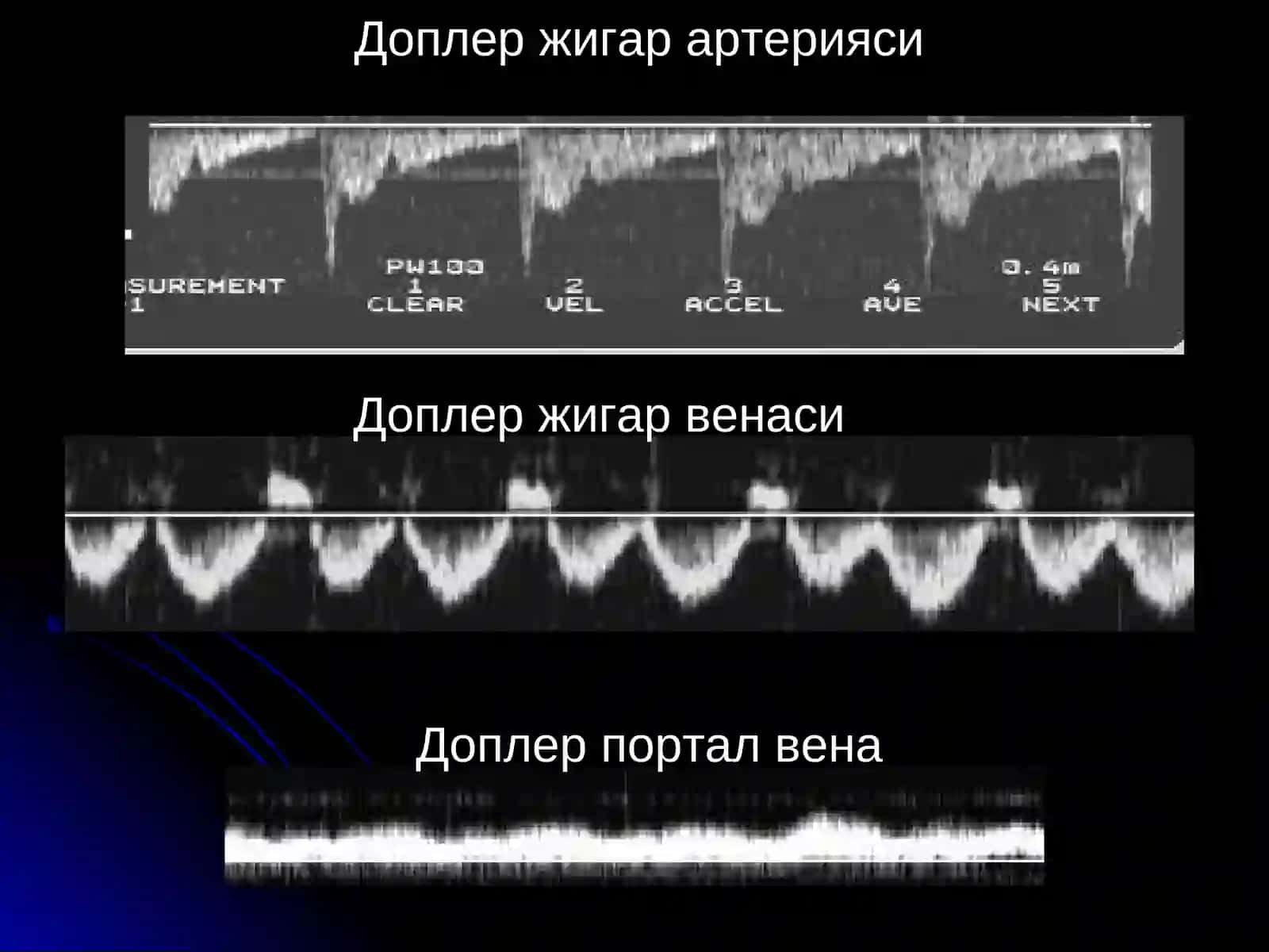 Жигар касалликалри нур ташхиси 4