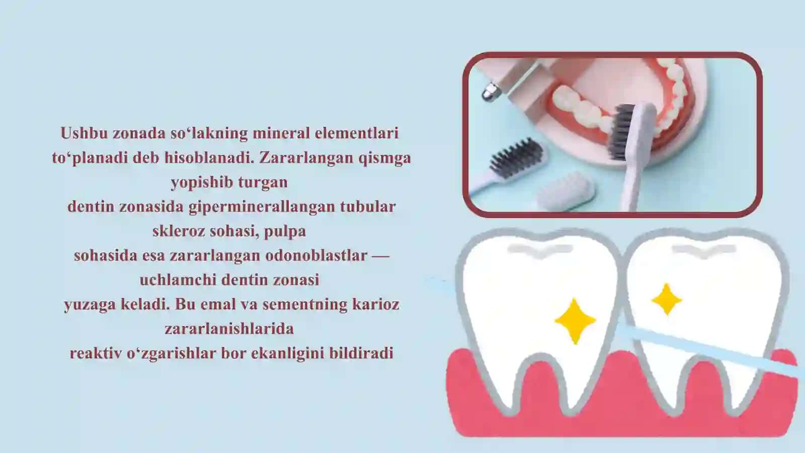 ILDIZ KARIYESI, KLINIKASI, TASHXISLASH, DAVOLASH 4