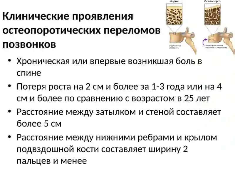 Остеопороз 4