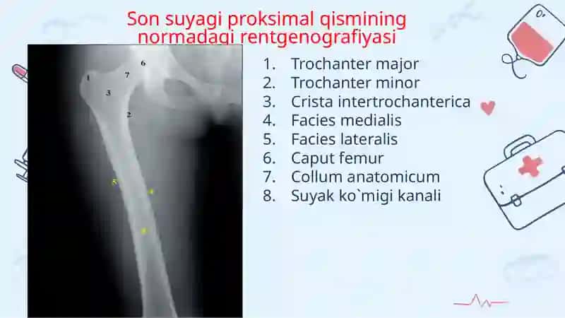 Son suyagi proksimal qismi sinishlari 4