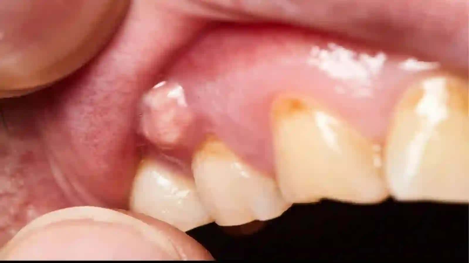 ZOʻRAYISHBOSQICHIDAGI SURUNKALIPERIODONTIT 4