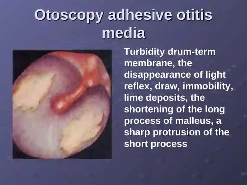 Adhesive otitis media 4