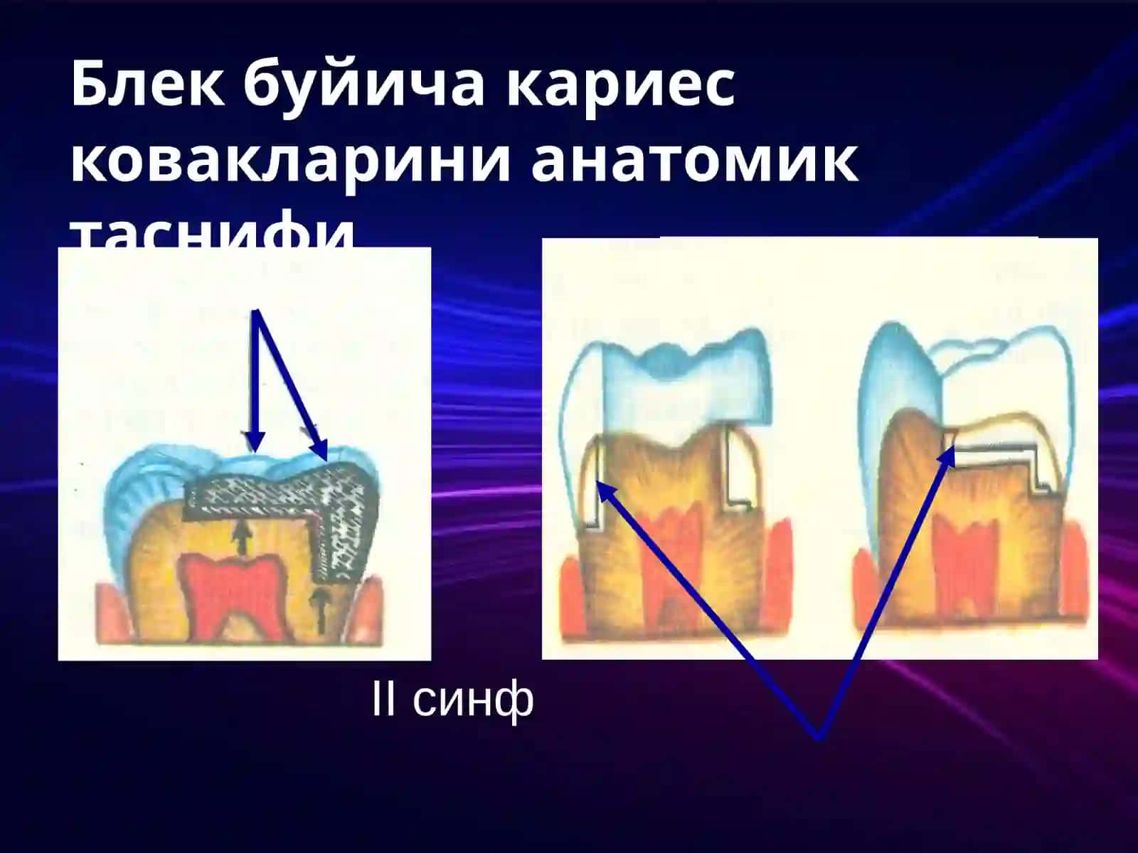 Karies kovagini charxlash bosqichlari 4