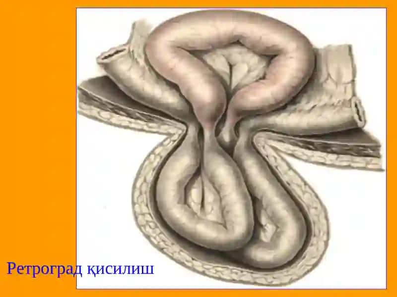 Чурранинг асоратлари 4