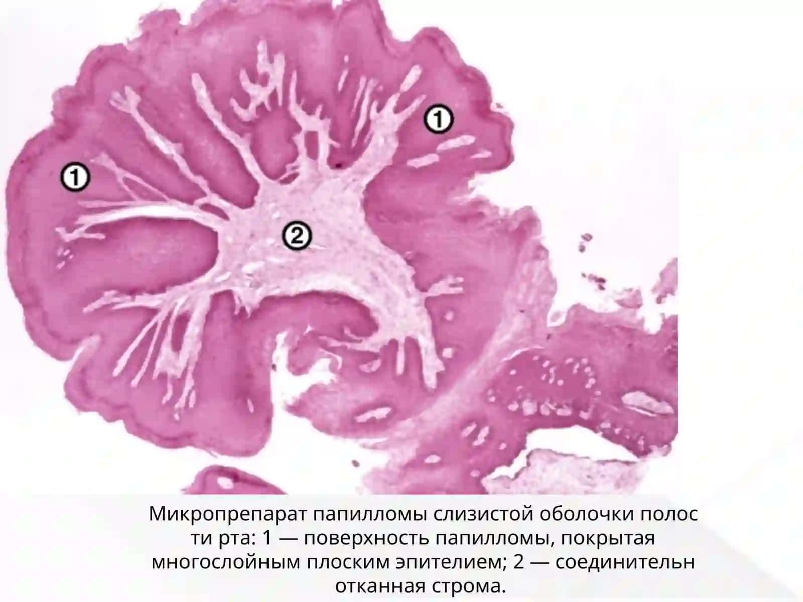 Эпителиальные опухоли 4