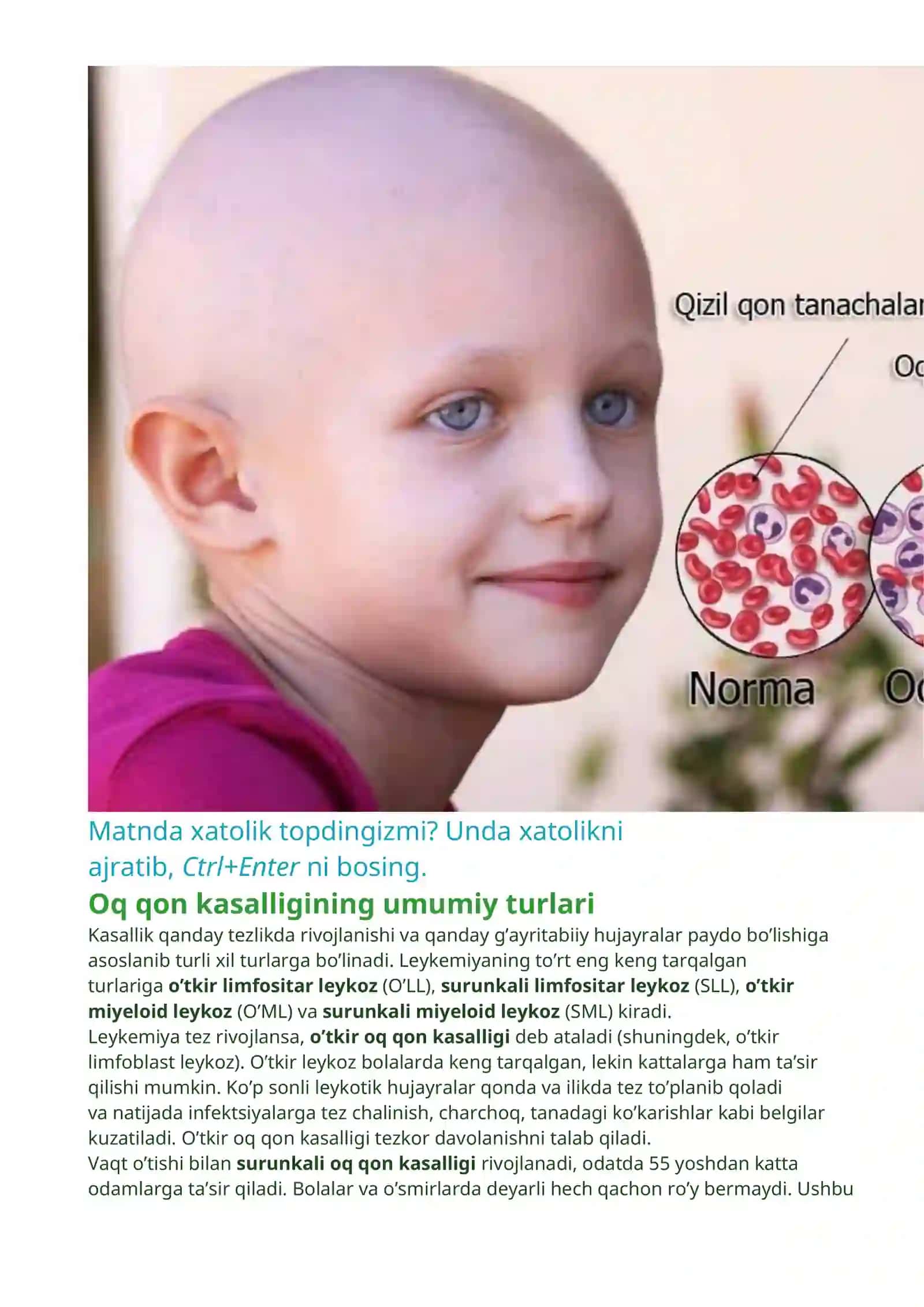 Leykoz Oq qon kasalligi 4