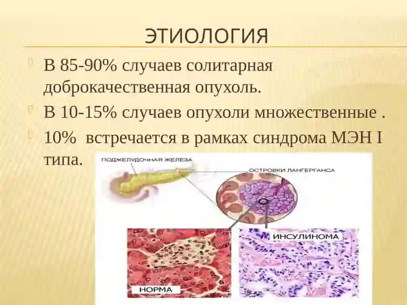INSULINOMA 4