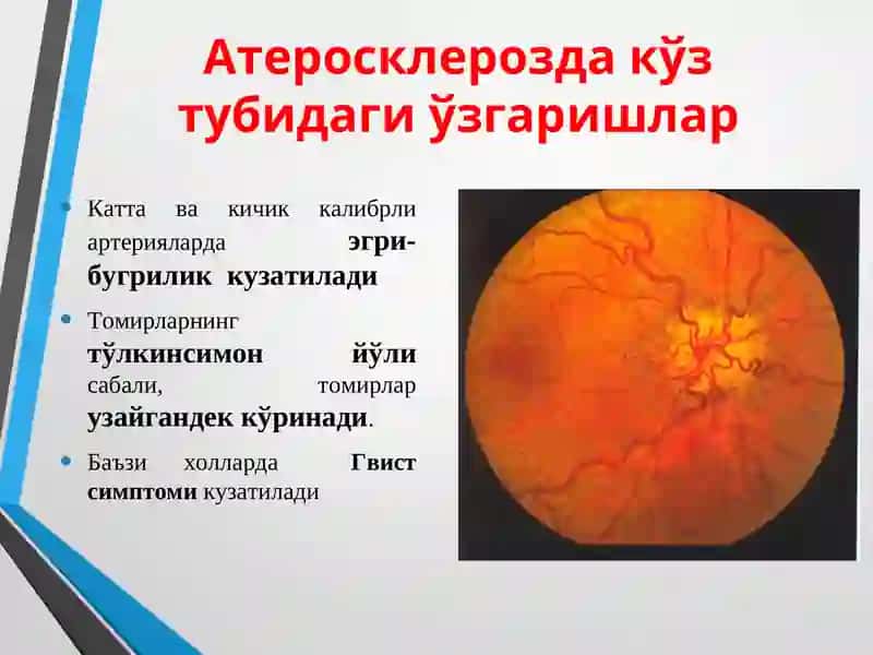 Атеросклероз 4