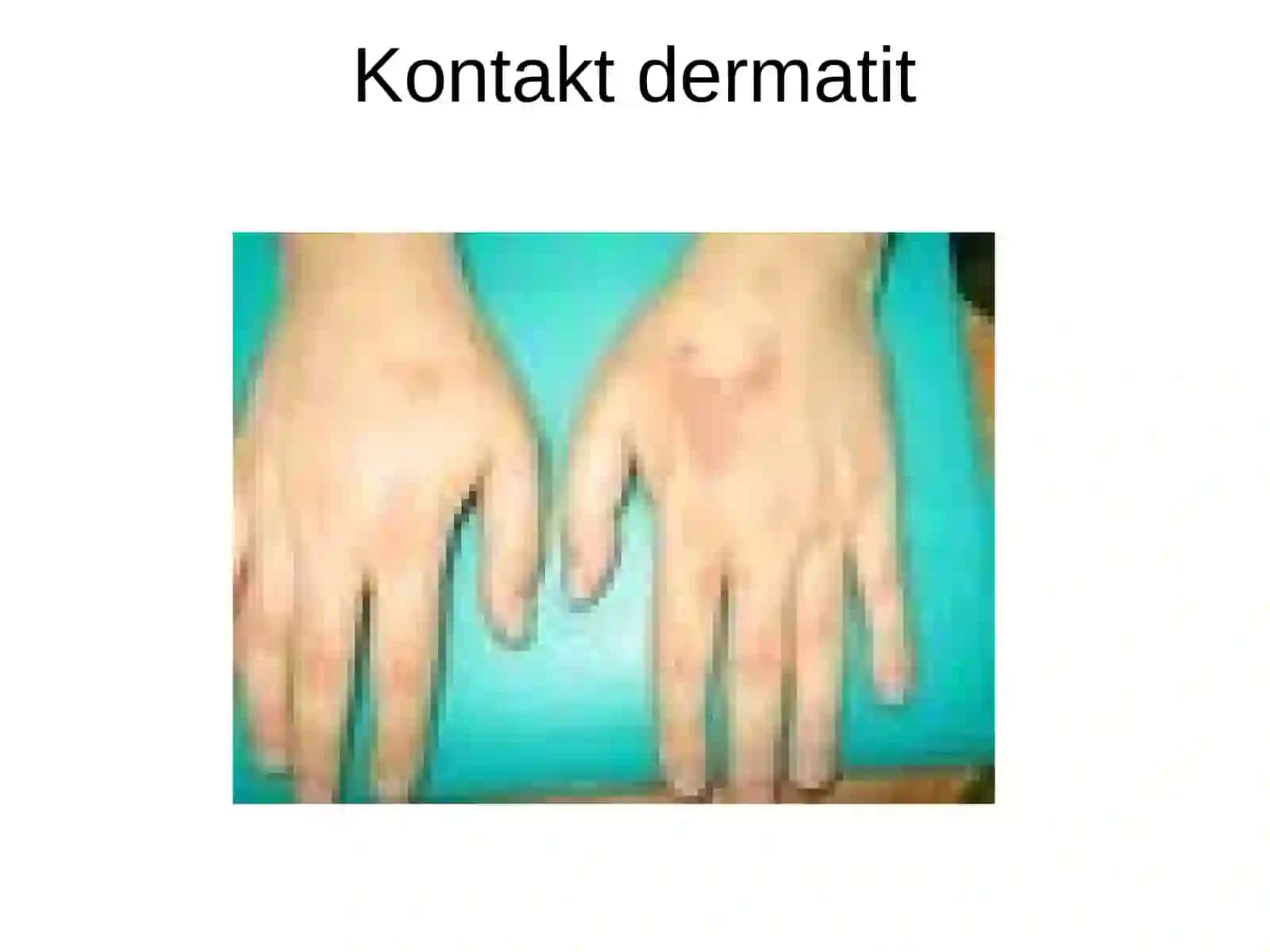 Dermatitlar 4