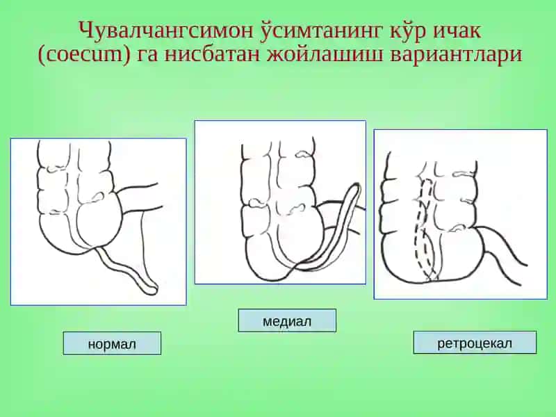 Ўткир аппендицит 4