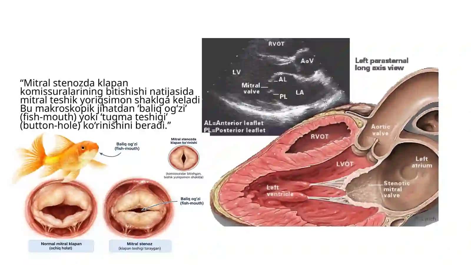 Mitral stenoz 4