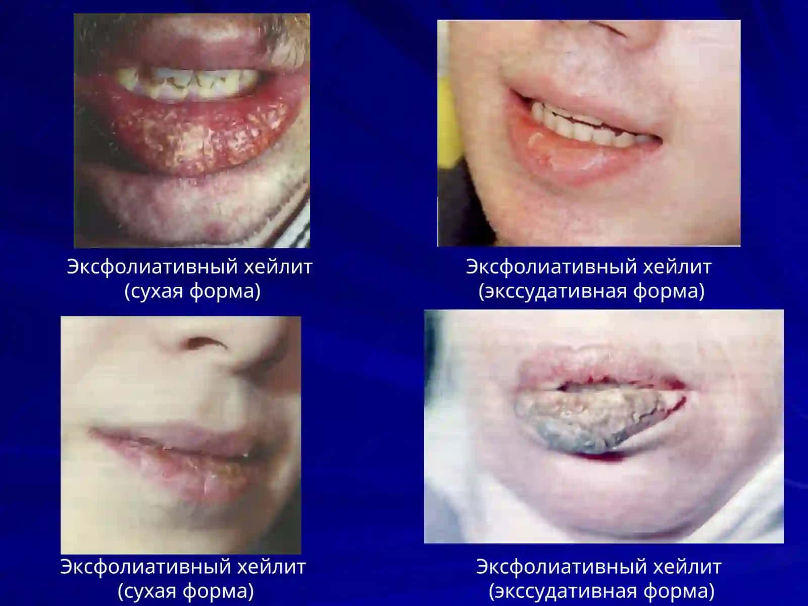 ХЕЙЛИТ И ЛЕПРА 4