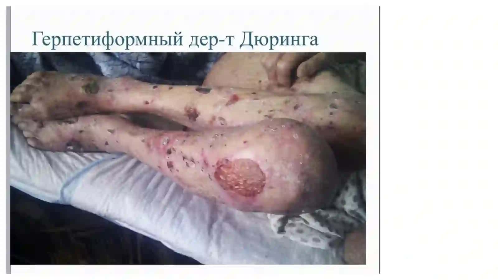 Герпетиформный дерматит Дюринга 4